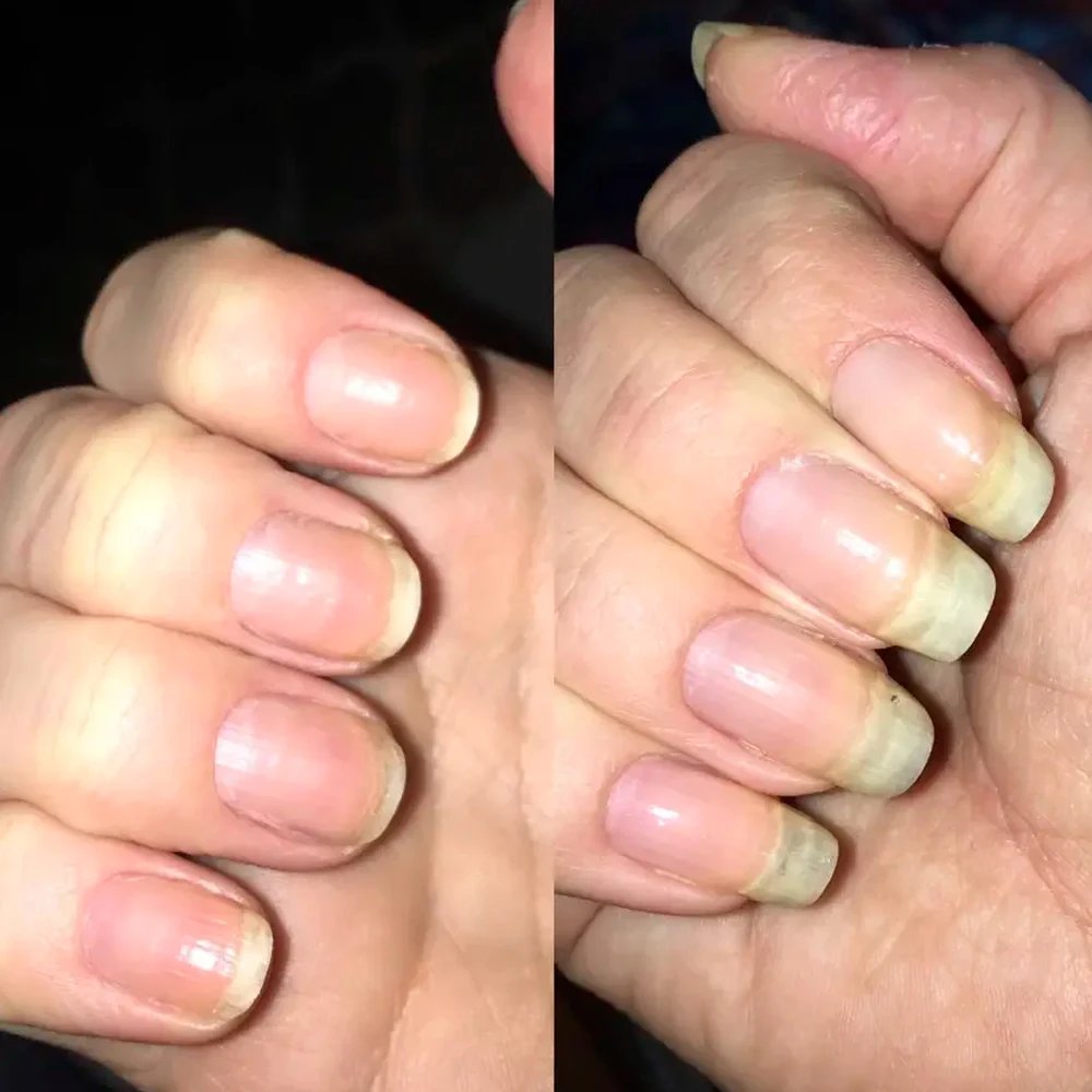 LOVCARRIE Nail Growth 5 to 7 Day Strong Nail Strengthener Calcium Protein Formula Strong Nails Hardener Protect Soft Thin Nails LOVCARRIE Nail Growth 5 to 7 Day Strong Nail Strengthener Calcium Protein Formula Strong Nails Hardener Protect Soft Thin Nails
