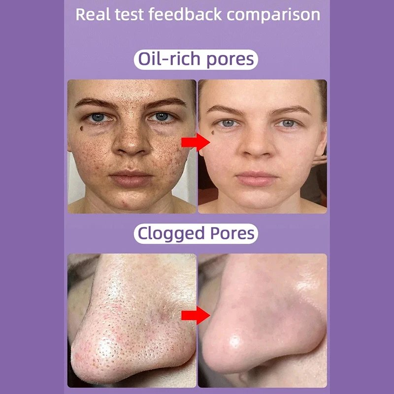 Salicylic Acid Pore Shrinking Cream Quick Remove Blackehead Elimination Large Pores Tighten Face Smooth Skin Care Products New Salicylic Acid Pore Shrinking Cream Quick Remove Blackehead Elimination Large Pores Tighten Face Smooth Skin Care Products New