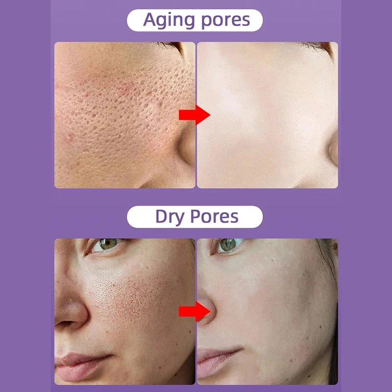 Salicylic Acid Pore Shrinking Cream Quick Remove Blackehead Elimination Large Pores Tighten Face Smooth Skin Care Products New Salicylic Acid Pore Shrinking Cream Quick Remove Blackehead Elimination Large Pores Tighten Face Smooth Skin Care Products New