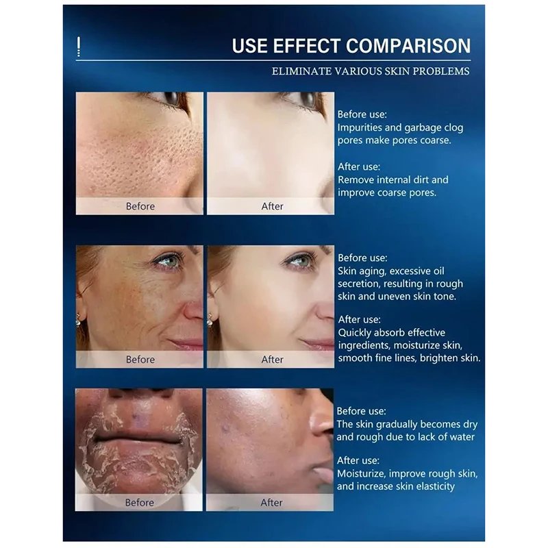 Salicylic Acid Pore Shrinking Cream Quick Remove Blackehead Elimination Large Pores Tighten Face Smooth Skin Care Products New Salicylic Acid Pore Shrinking Cream Quick Remove Blackehead Elimination Large Pores Tighten Face Smooth Skin Care Products New