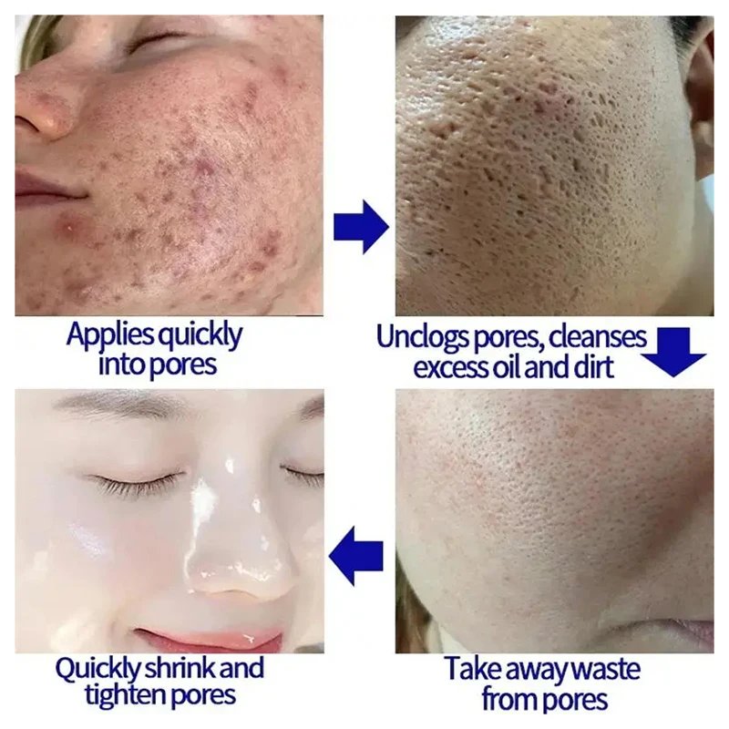 Salicylic Acid Pore Shrinking Cream Quick Remove Blackehead Elimination Large Pores Tighten Face Smooth Skin Care Products New Salicylic Acid Pore Shrinking Cream Quick Remove Blackehead Elimination Large Pores Tighten Face Smooth Skin Care Products New
