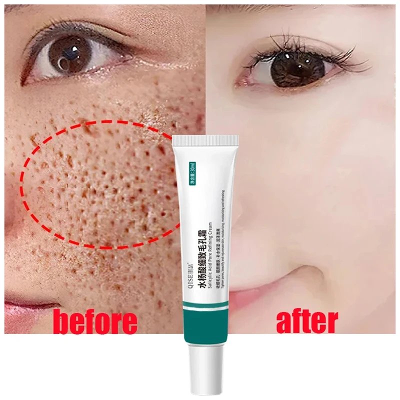 Salicylic Acid Pore Shrinking Cream Quick Remove Blackehead Elimination Large Pores Tighten Face Smooth Skin Care Products New Salicylic Acid Pore Shrinking Cream Quick Remove Blackehead Elimination Large Pores Tighten Face Smooth Skin Care Products New