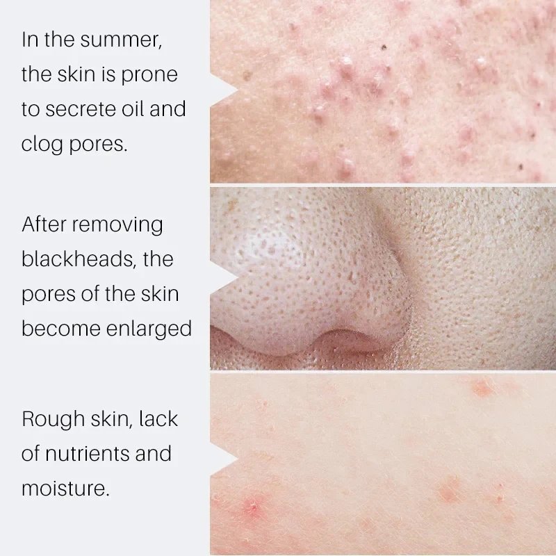 Salicylic Acid Pore Shrinking Cream Quick Remove Blackehead Elimination Large Pores Tighten Face Smooth Skin Care Products New Salicylic Acid Pore Shrinking Cream Quick Remove Blackehead Elimination Large Pores Tighten Face Smooth Skin Care Products New